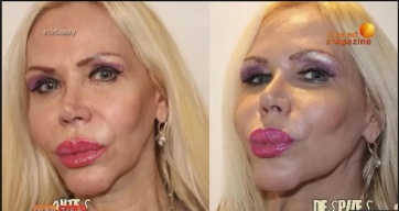 Alejandra Pradón se sometió a un rejuvenecimiento vaginal en vivo