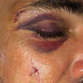 Luciano Castro se accidentó surfeando y recibió varios puntos en la cara