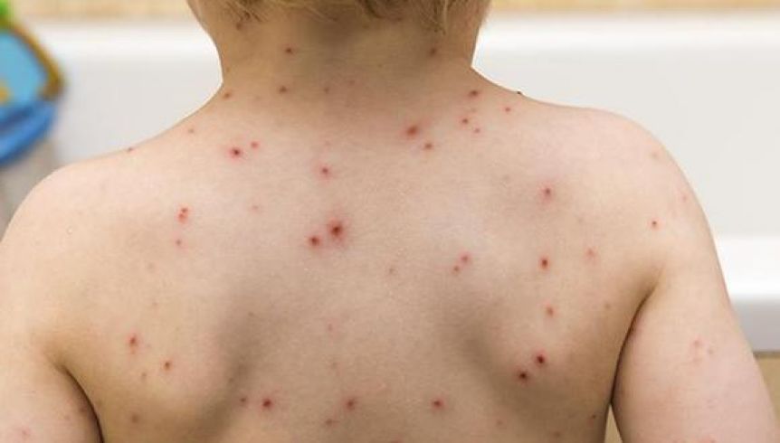 Viruela del mono: Estados Unidos declaró emergencia sanitaria